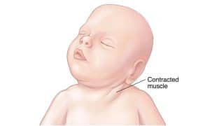 Neck Tightness And Movement Preferences In Infants (Torticollis Explained)